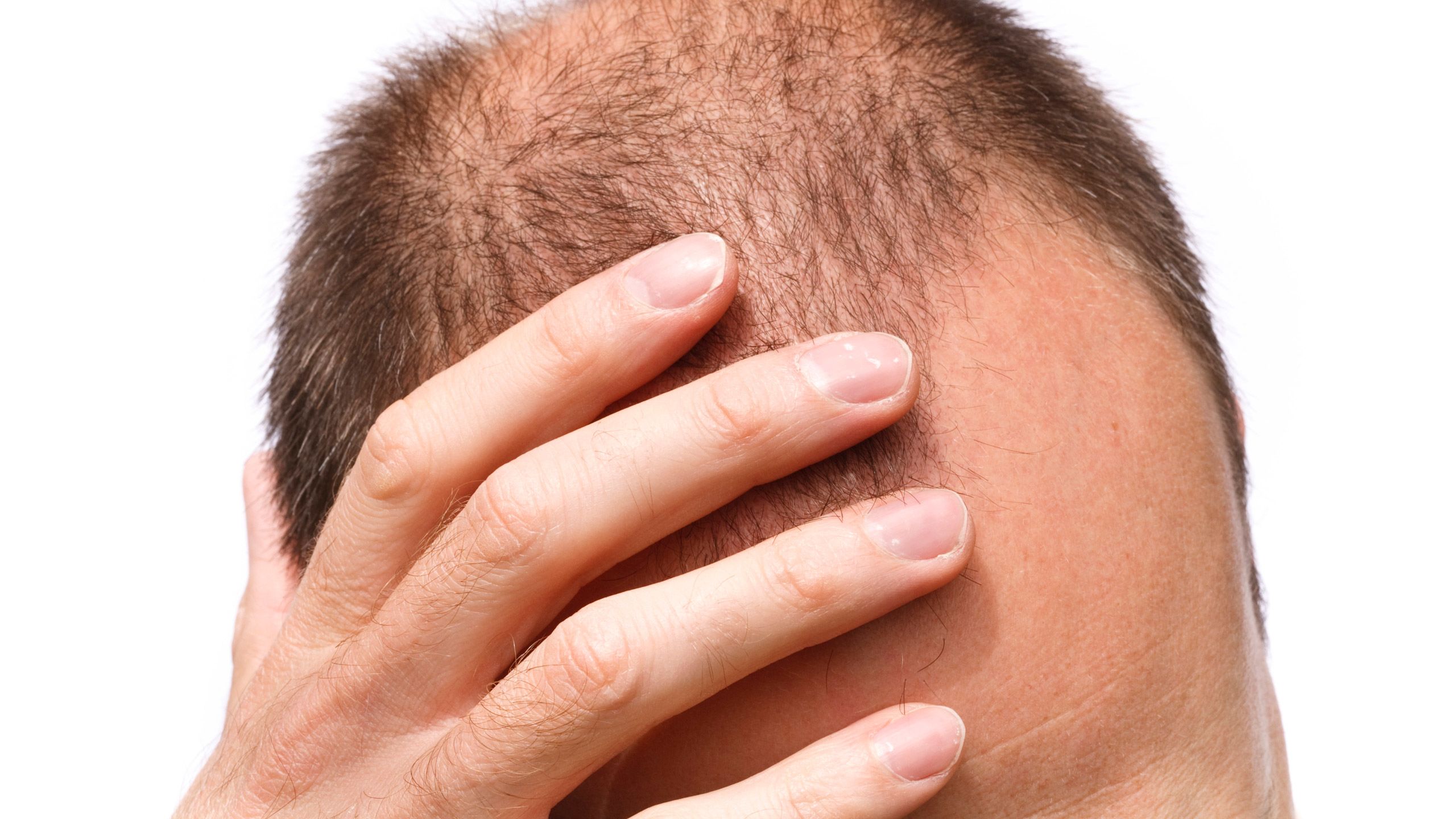 stress menyebabkan botak obati botak genetik pria dengan tricotherapy 2